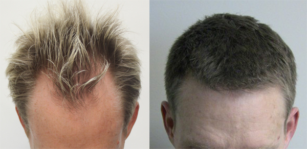 can hair regrow in bald areas